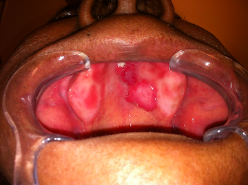 Salivary Gland Tumors doctorlansford.com